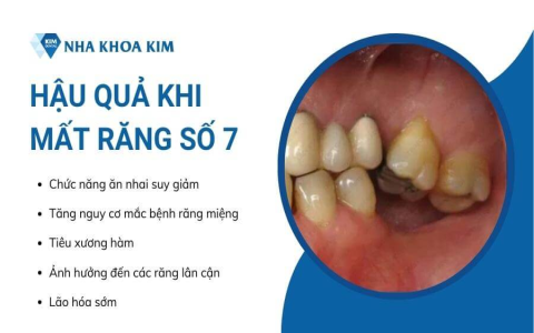 Nằm mơ nhổ răng hàm dưới có ý nghĩa gì?Giải mã ngay!