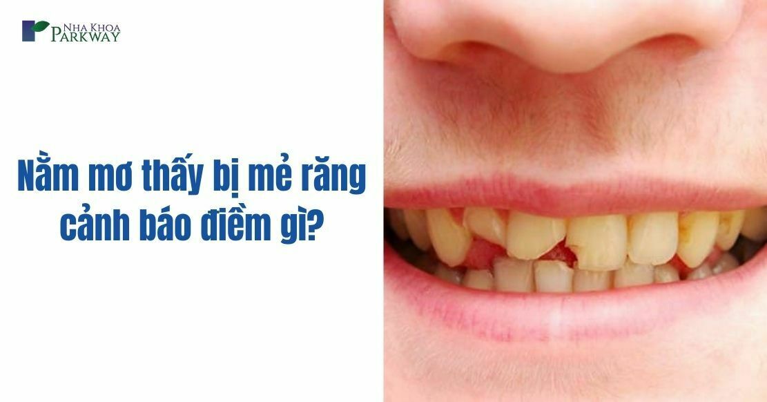 Tại sao bạn nằm mơ thấy răng bị mẻ? Nguyên nhân và cách hóa giải